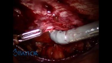 An IMage From "Laparoscopic Inguinal Hernia Repair Using TAPP Approach and ULTRAPROD ADVANCED™ Mesh with Tim Tollens, MD"