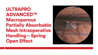 An Image From "ULTRAPRO ADVANCED™ Macroporous Partially Absorbable Mesh Intra-Operative Handling"
