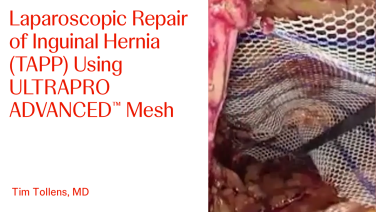 An Image From "Laparoscopic Repair of Inguinal Hernia (TAPP) Using ULTRAPROD ADVANCED™ Mesh with Tim Tollens, MD