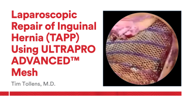 An Image From "Laparoscopic Repair of Inguinal Hernia (TAPP) Using ULTRAPROD ADVANCED™ Mesh with Tim Tollens, MD"