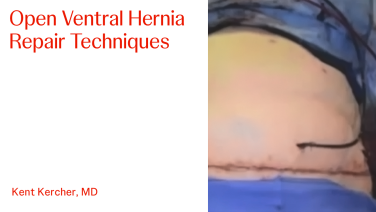 An Image From "Open Ventral Hernia Repair Techniques with Kent Kercher, MD"
