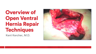 An Image From "Overview of Open Ventral Hernia Repair Techniques with Kent Kercher, MD"