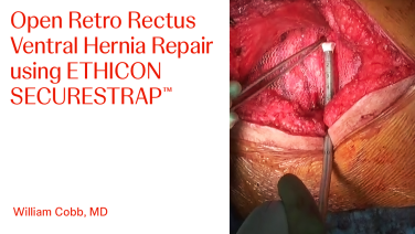 An Image From "Open Retro Rectus Ventral Hernia Repair using ETHICON SECURESTRAP™ with William Cobb, MD"