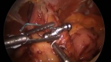 LINX Reflux Management System - Clasp Closure