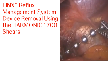 An Image From "LINX™ Reflux Management System Device Removal Using the HARMONIC™ 700 Shears"