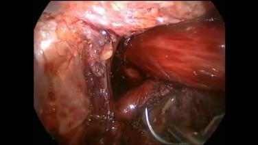 An Image From "Large Hiatal Hernia Repair Using LINX with John Lipham, MD"