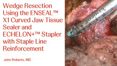 An Image From "Wedge Resection Using the ENSEAL™ X1 Curved Jaw Tissue Sealer with John Roberts, MD"