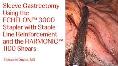 An Image From "Sleeve Gastrectomy Using the ECHELON™ 3000 Stapler with Staple Line Reinforcement and Harmonic™ 1100 Shears with Betsy Dovec, MD"