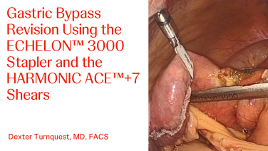 An image from "Gastric Bypass Revision with the ECHELON 3000 stapler"