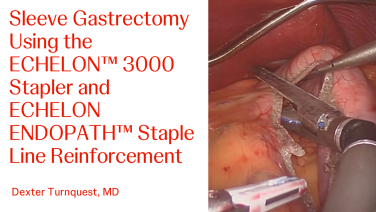 An Image From "Sleeve Gastrectomy Using the ECHELON™ 3000 Stapler and ECHELON ENDOPATH™ Staple Line Reinforcement with Dexter Turnquest, MD"