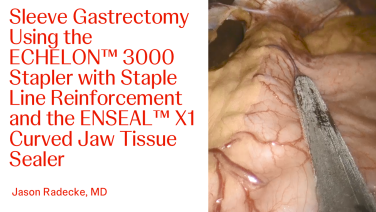 An Image From "Sleeve Gastrectomy with the ECHELON 3000 stapler, ECHELON Staple Line Reinforcement, and ENSEAL X1 Curved Jaw Tissue Sealer"