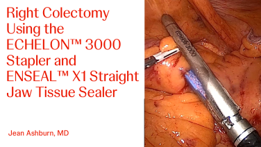 An Image From "Right Colectomy Using the ECHELON 3000 Stapler and ENSEAL X1 Straight Jaw with Jean Ashburn, MD"