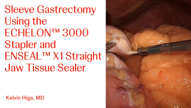 An Image From "Sleeve Gastrectomy using the ECHELON 3000 Stapler with Kelvin Higa, MD"