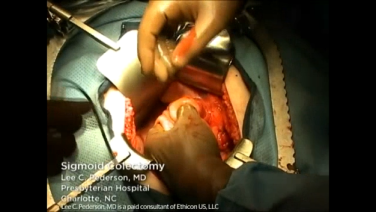 An Image From "Left Sigmoid Colectomy Using the ETHICON™ Linear Cutter with Lee Pederson, MD"