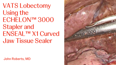 An Image From "VATS Lobectomy Using the ECHELON™ 3000 Stapler and ENSEAL™ X1 Curved Jaw Tissue Sealer with John Roberts, MD"