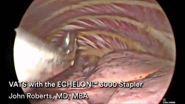 An Image From "Watch this video to learn more as Dr. Roberts performs a VATS procedure using the ECHELON™ 3000 stapler. This content is intended for Health Care Professionals in the United States. "