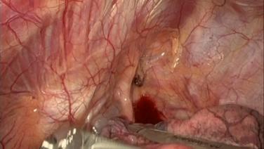 An Image From "ECHELON ENDOPATH™ Staple Line Reinforcement on SureForm in Robotic Lobectomy with Emily Cassidy, MD"