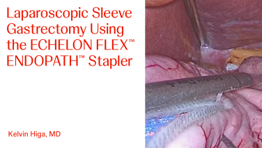 An Image From "Laparoscopic Sleeve Gastrectomy Using the ECHELON FLEX™ ENDOPATH™ Stapler with Kelvin Higa, MD"