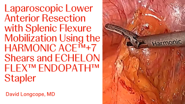 An Image From "Laparoscopic Lower Anterior Resection with Splenic Flexure Mobilization Using HARMONIC ACE™+7 Shears and ECHELON FLEX™ ENDOPATH™ Stapler with David Longcope, MD"