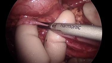 Donor Nephrectomy Using HARMONIC ACE™+7 Shears with Tayyab Diwan, MD thumbnail
