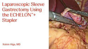 An Image From "Laparoscopic Sleeve Gastrectomy Using the ECHELON™+ Stapler with Kelvin Higa, MD"