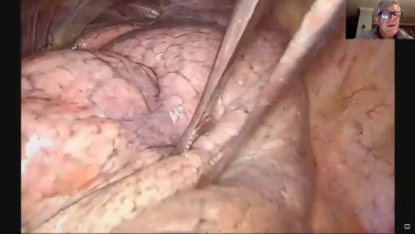 An image from " Left Lower Lobectomy After Immunotherapy Using the ECHELON 3000 Stapler with Scott Swanson, MD"