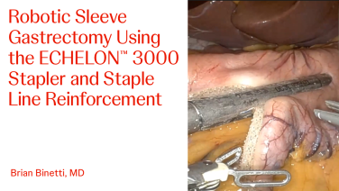 An Image From "Robotic Sleeve Gastrectomy Using the ECHELON™ 3000 Stapler and Staple Line Reinforcement with Brian Binetti, MD"