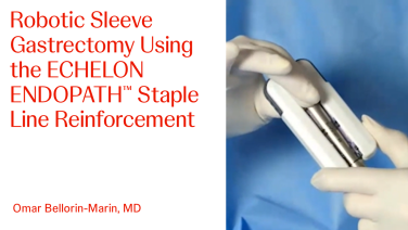 An Image From "Robotic Sleeve Gastrectomy Using the ECHELON ENDOPATH™ Staple Line Reinforcement with Omar Bellorin-Marin, MD"