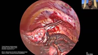 An Image From "Wedge Resection Using the ECHELON™ 3000 Stapler with Keith Mortman, MD"