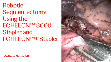 An Image From "Robotic Segmentectomy Using the ECHELON™ 3000 Stapler and ECHELON™+ Stapler with Mathew Ninan, MD"