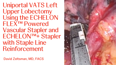 An Image From "Uniportal VATS Left Upper Lobectomy Using the ECHELON FLEX™ Powered Vascular Stapler and ECHELON™+ Stapler with Staple Line Reinforcement with David Zeltsman, MD"