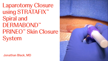 An Image From "Laparotomy Closure using STRATAFIX™ Spiral and DERMABOND™ PRINEO™ Skin Closure System with Jonathan Black, MD"