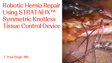 An Image From "Robotic Hernia Repair using STRATAFIX™ Symmetric Knotless Tissue Control Device with T. Paul Singh, MD "
