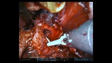 An Image From "Robotic Prostatectomy Using STRATAFIX™ Spiral Knotless Tissue Control Device with Jorn Witt, MD"