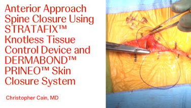 An image from the "Anterior Approach Spine Closure Using STRATAFIX™ Knotless Tissue Control Device and DERMABOND™ PRINEO™ Skin Closure System with Christopher Cain, MD" video on the JnJInstitute.com website.