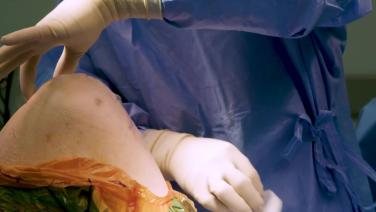 An image from the "DERMABOND® PRINEO® Total Knee Replacement Surgery - Wound Drainage with James Dowd, MD" video on the JnJInstitute.com website.