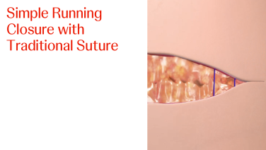 An image from the "Simple Running Closure with Traditional Suture" video on the JnJInstitute.com website.