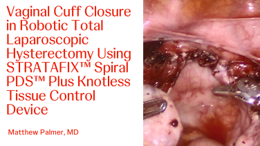 An image of the "Vaginal Cuff Closure in Robotic Total Laparoscopic Hysterectomy Using STRATAFIX™ Spiral PDS™ Plus Knotless Tissue Control Device with Matthew Palmer, MD" video.