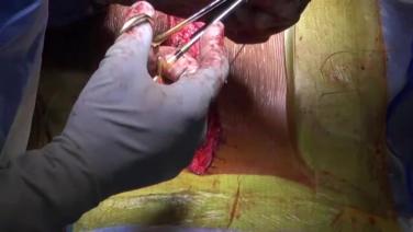 An image From "Spinal Fusion Wound Closure Using STRATAFIX™ Knotless Tissue Control Device with Suken Shah, MD"