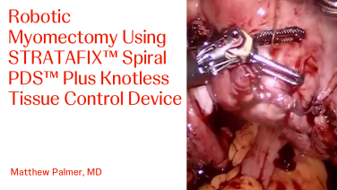 An image of the "STRATAFIX™ Spiral PDS™ Plus Knotless Tissue Control Device in a Robotic Myomectomy" video.