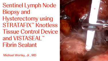 An Image From "Sentinel Lymph Node Biopsy and Hysterectomy Using STRATAFIX™ Knotless Tissue Control Device and VISTASEAL™ Fibrin Sealant with Michael Worley, Jr., MD"
