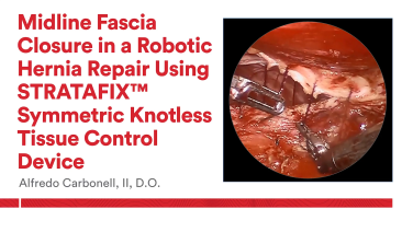 An Image From "Midline Fascia Closure in a Robotic Hernia Repair Using STRATAFIX™ Symmetric PDS Knotless Tissue Control Device with Alfredo Carbonell, II, DO"