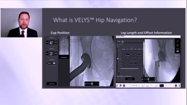 Slide of Xray from VELYS Hip Navigation Technology Overview and Clinical Benefits