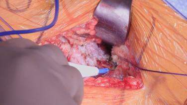 ANTERIOR ADVANTAGE MATTA METHOD Procedural Workflow with Anay Patel, MD thumbnail