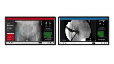 ANTERIOR ADVANTAGE™ THA with Hana® Table Procedural Workflow with Anay Patel, MD