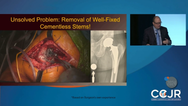 Revision Hip Arthroplasty: WATSON EXTRACTION System with William Hamilton, MD thumbnail