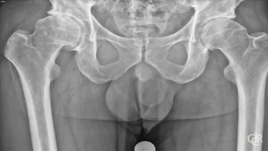 X-ray of a hip from ANTERIOR ADVANTAGE™ Total Hip Arthroplasty with Hana® Table Live Demonstration with Charles DeCook, MD