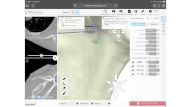 GUI from the software from TRUMATCH Software Demo for Reverse Total Shoulder Arthroplasty with Michael Wiater, MD
