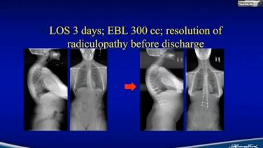 Slide from a power point of Xrays from Role of Graft Materials in Oncology Patients with Frank LaMarca, MD