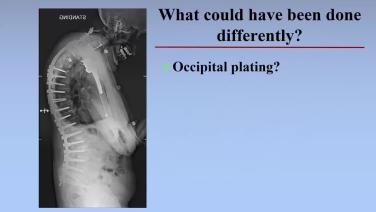 Slide from Surgical Management of Cervical Deformity and Cervical Spine Reconstruction with Khlaled Kebaish, MD; Hamid Hassanzadeh, MD; Justin Smith, MD
